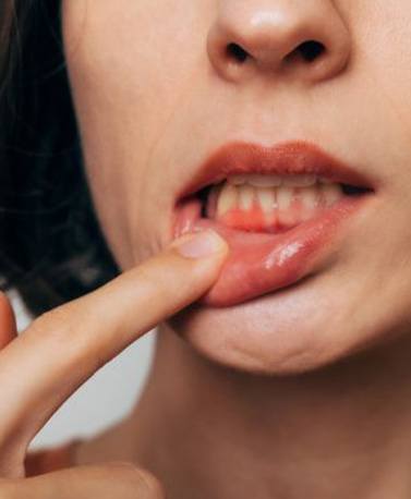 Lady shows inflamed gum tissue