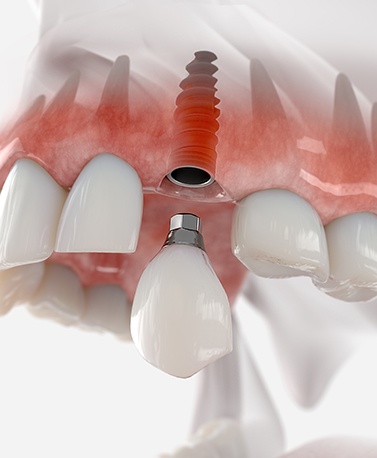 an illustration showing a dental implant being placed 