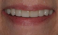 Brighter smile with teeth of proper length