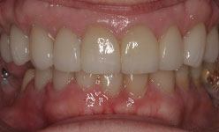 Close-up of teeth after facial collapse treatment
