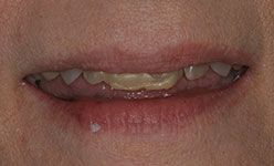 Close-up of smile with shortened, dull teeth