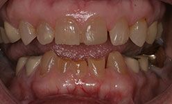 Close-up of badly worn down and discolored teeth