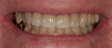 After Smile