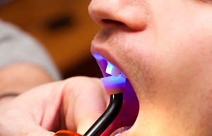curing light being used to harden bonding 