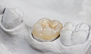 Model smile with dental crown restoration