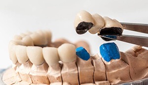 Model smile with fixed bridge restoration
