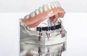 Model smile with implant denture