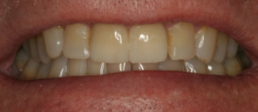 After Smile
