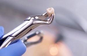 A pair of dental pliers used to perform tooth extractions in Bullard