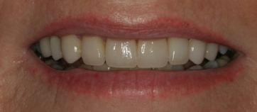 After Smile