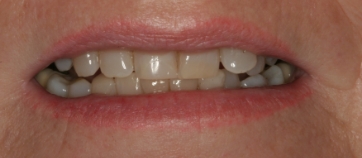 Before Smile