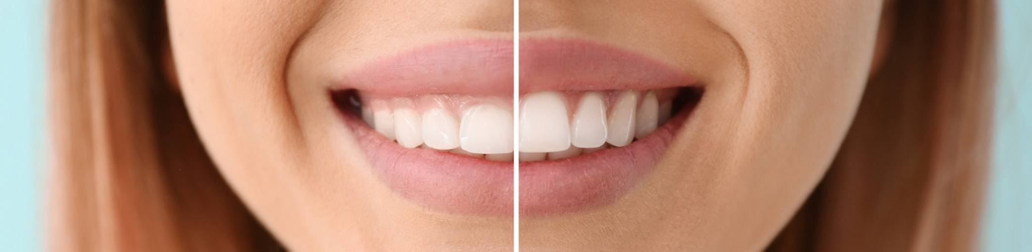 A woman before and after a cosmetic gum lift