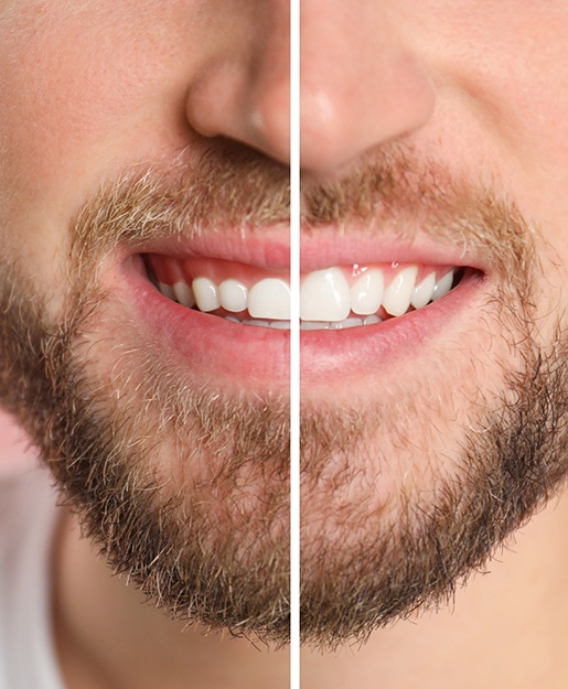 A man before and after a cosmetic gum lift
