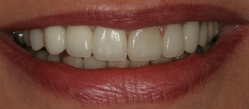 After Smile