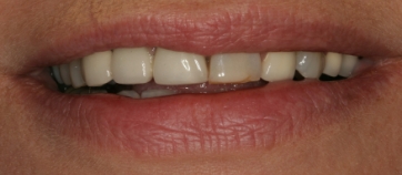 Before Smile