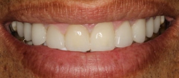 After Smile