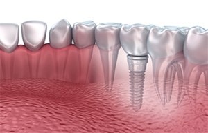 single unit dental implant