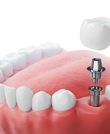 Profile view of components of single dental implant in lower arch with white background