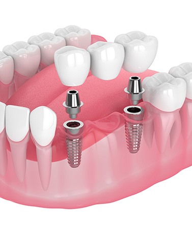 Illustration of two dental implants in lower arch anchoring bridge with white background