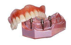 Model implant retained dentures