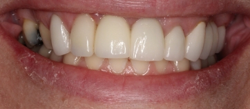 After Smile