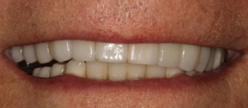 After Smile
