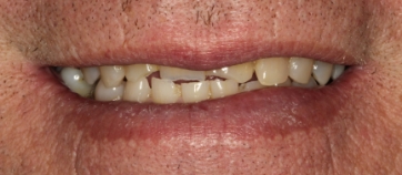 Before Smile