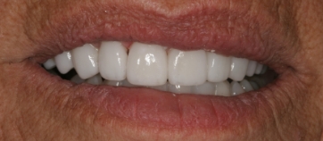 After Smile