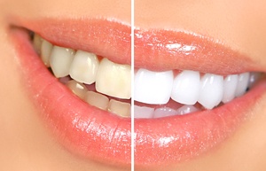 Half white smile