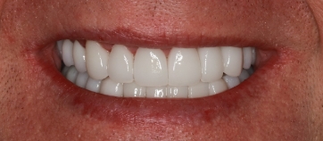 After Smile