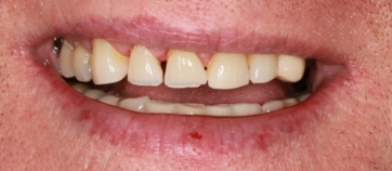Before Smile