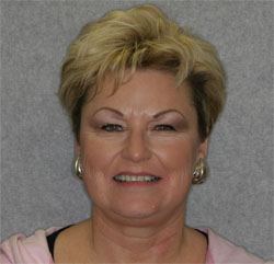 Older female patient before smile makeover