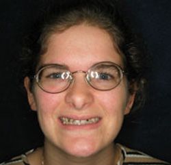 Female patient with glasses and damaged teeth