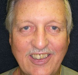 Older man with larger teeth before smile makeover
