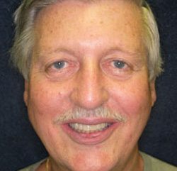 Older man with smaller teeth after smile makeover