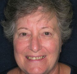 Senior woman with damaged and discolored teeth