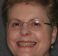 Woman with glasses and yellowed teeth