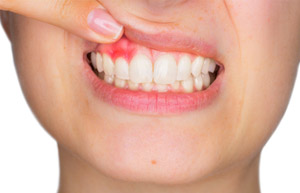 Woman showing red gums