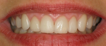 After Smile
