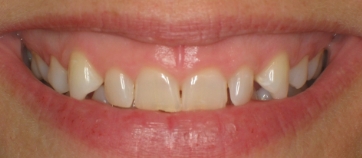 Before Smile