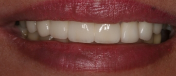 After Smile