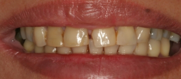 Before Smile