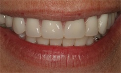 Brightened front teeth