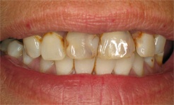 Darkened front teeth