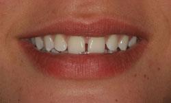 Smile with gaps between multiple teeth