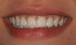 Smile with gaps closed