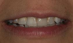 Dull smile prior to treatment