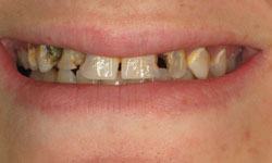 Smile with multiple damaged and missing teeth