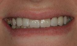 Smile after teeth have been repaired and replaced