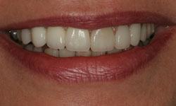 Smile after teeth have been lengthened